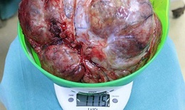 Khối u vú nặng 1,7kg khiến các bác sĩ cũng phải "choáng váng"
